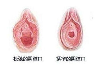 阴道紧缩术对比示意图