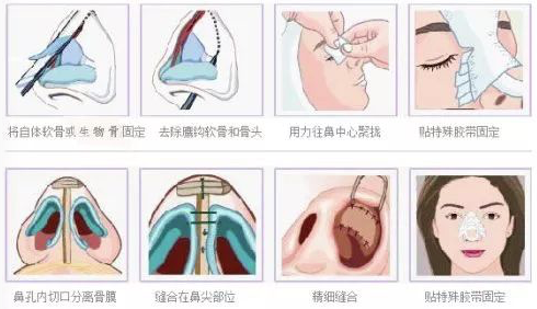 3d仿生隆鼻手术方法示意图