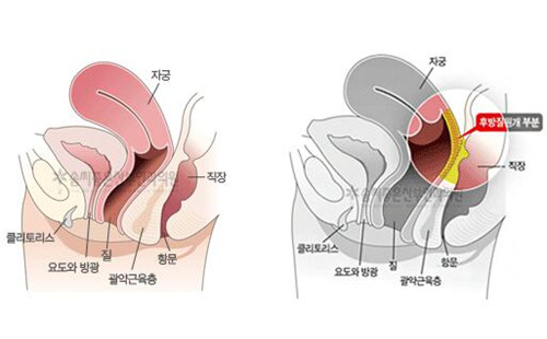 阴道紧缩术后，压力性漏尿真的可以改善吗？