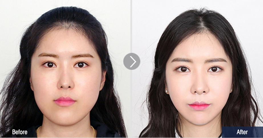 韩国faceline下颌角整形对比案例