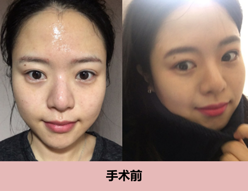 韩国id医院修复隆鼻失败手术真人案例分享 非常爱美