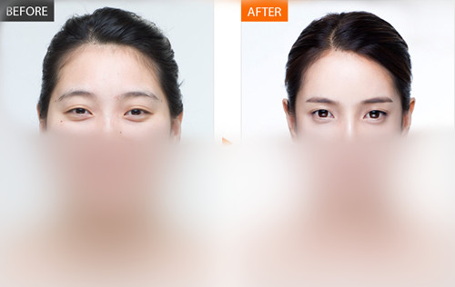 韩国巴诺巴奇医院双眼皮修复案例对比