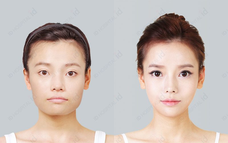 韩国ID整形外科颧骨整形对比案例