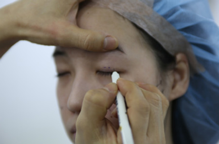 韩国eve院长郑润载修复内眼角手术有没有后遗症？