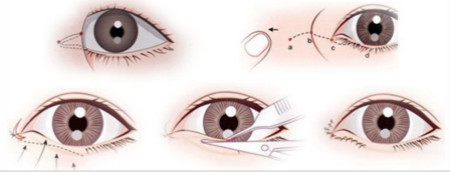 内眼角修复手术过程示意图