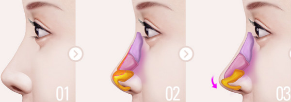 鼻整形手术示意图
