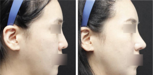 鼻整形手术案例侧面对比图