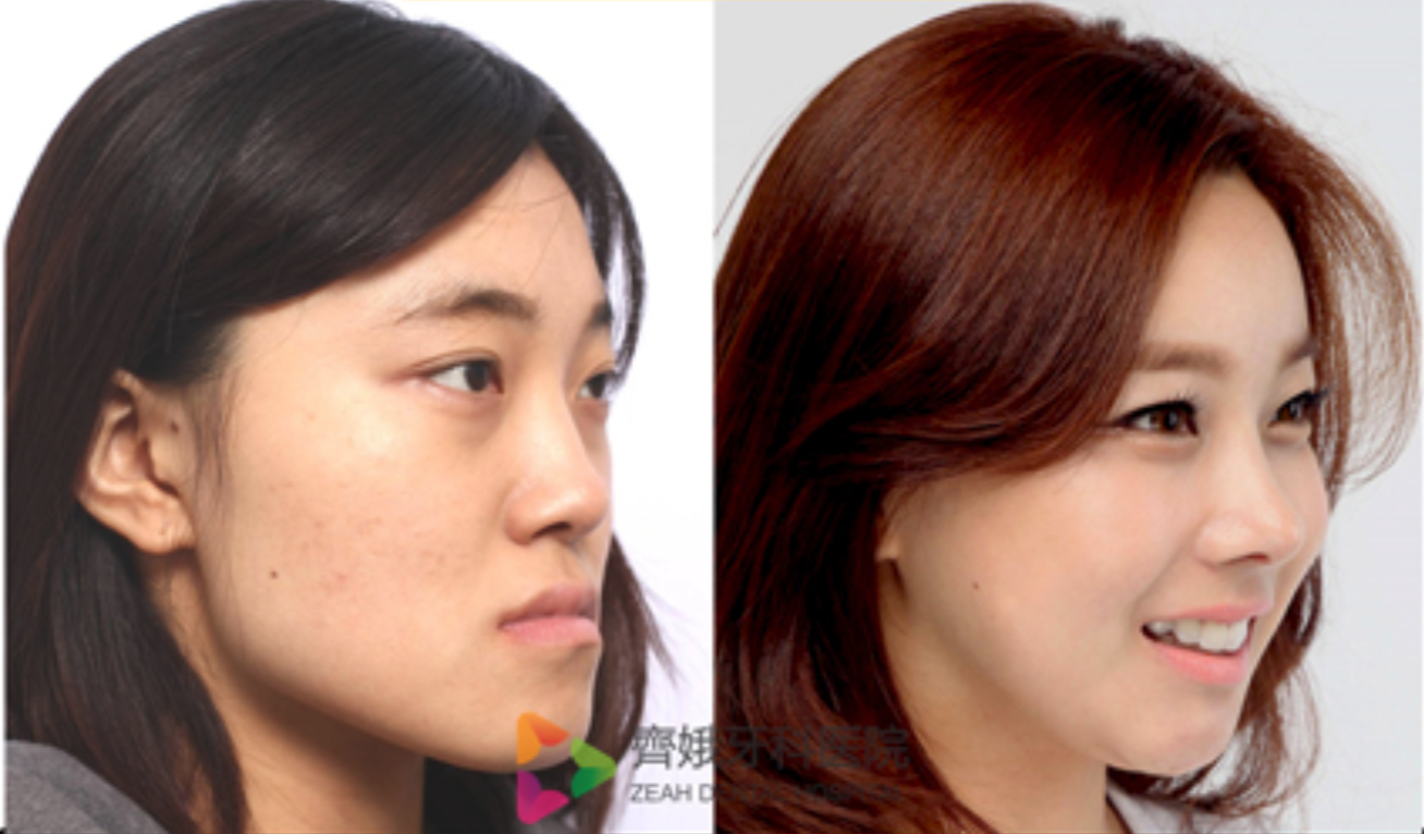 韩国面部轮廓手术真人案例