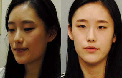 韩国ID整形外科轮廓术前照片展示