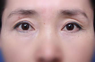BIO医院双眼皮手术失败展示