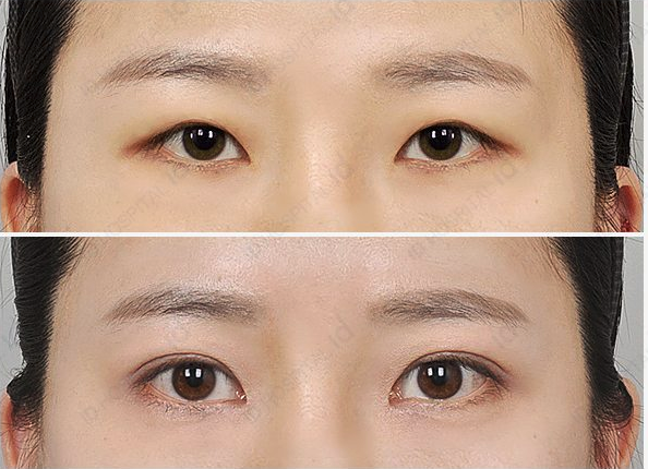 韩国id整形医院眼部手术对比