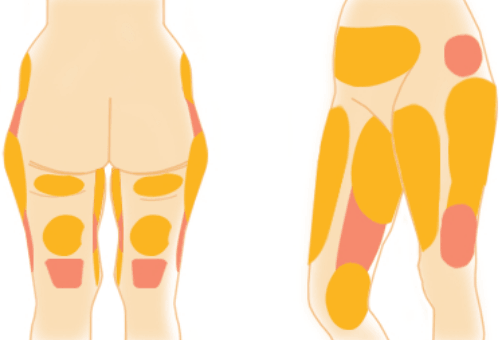 大腿脂肪堆积部位示意图