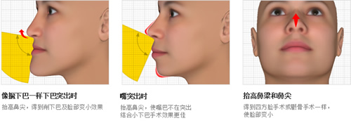 高诺鼻整形外科隆鼻特点分析