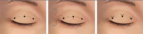 埋线双眼皮手术过程图