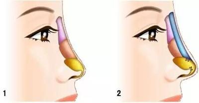 假体隆鼻手术示意图