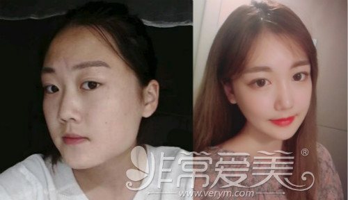 曝光：韩国一路美脸型整形特色+真人案例分析！