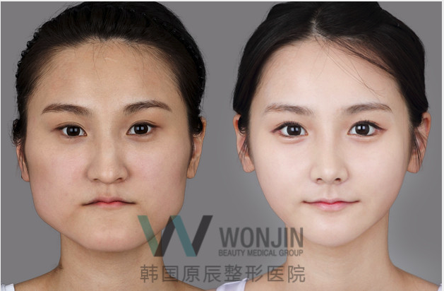 韩国原称面部轮廓手术对比图