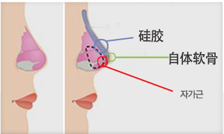 韩国隆鼻手术示意图