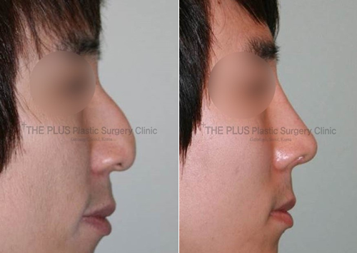 韩国德嘉整形外科男士隆鼻案例对比