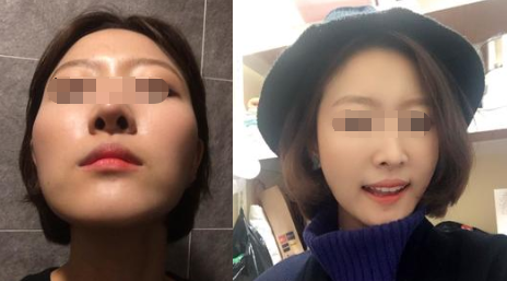 韩国美迪莹整形外科轮廓手术真人案例
