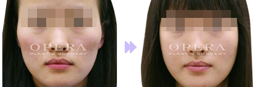 韩国欧佩拉整形外科改脸型对比案例