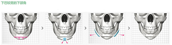 下巴较宽的下颌角整形方法