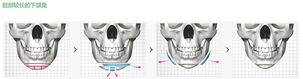 脸较长的下颌角整形方法