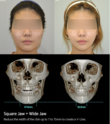 下颌角整形手术案例对比图