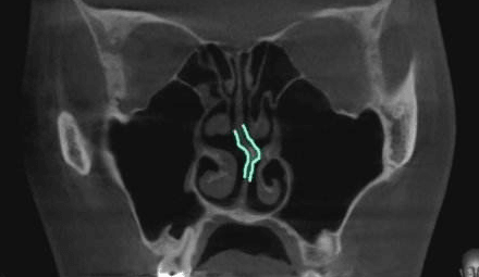 鼻CT检测图片