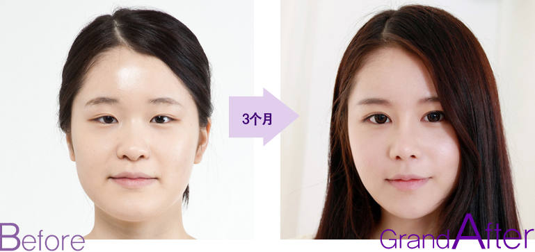 韩国高兰得整形外科双眼皮对比案例