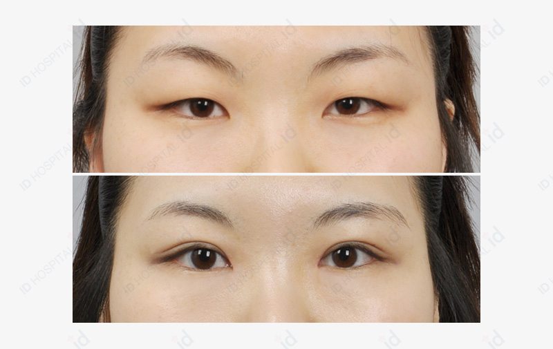 韩国高id整形外科双眼皮整形对比案例