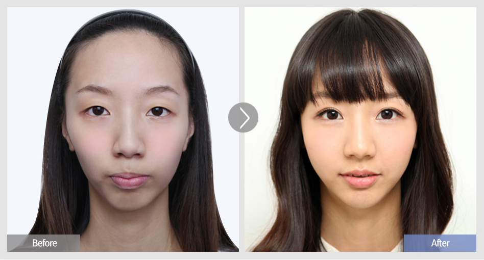 韩国faceline整形外科双眼皮整形案例