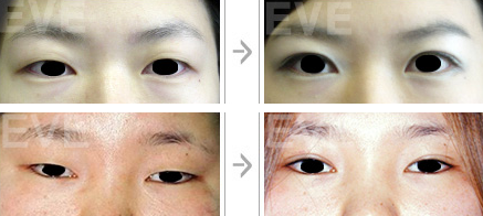eve整形外科双眼皮手术案例对比