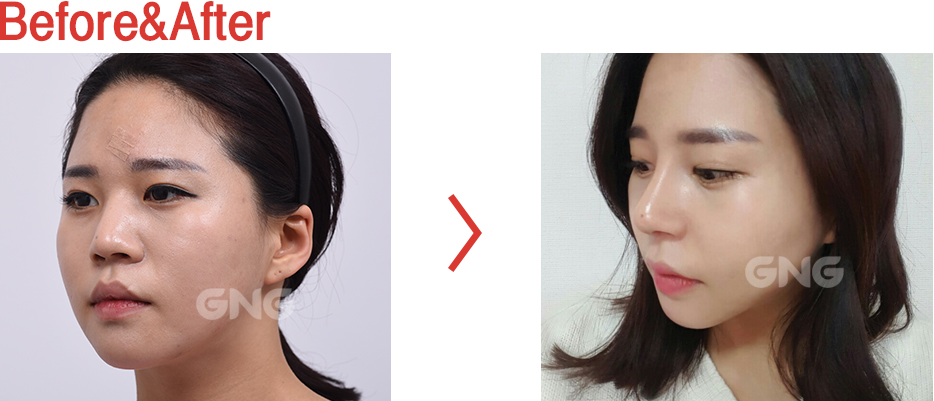 韩国GNG整形外科隆鼻案例