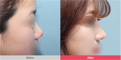 韩国首尔丽丝塔整形外科隆鼻案例