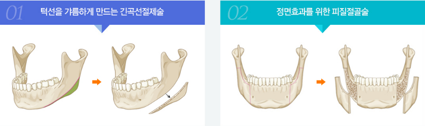 韩国布拉德整形外科下颌角示意图