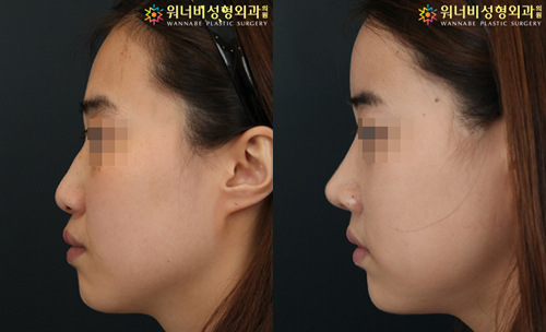 韩国奥纳比整形外科隆鼻真人案例