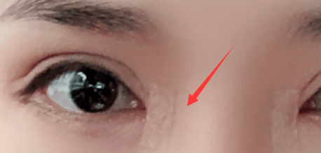 韩国eve修复内眼角示意图