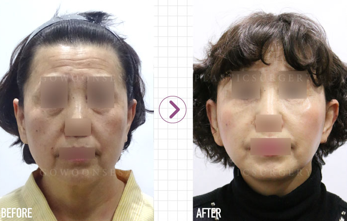 韩国德丽珍整形外科面部提升除皱术的价格贵吗