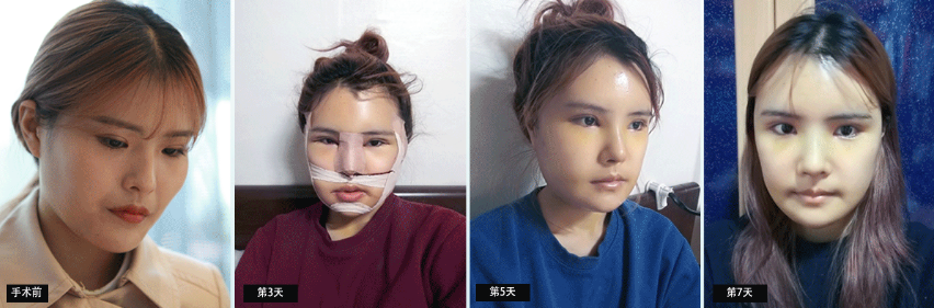 韩国faceline整形真人秀揭：下颚角颧骨手术后多久可以上班