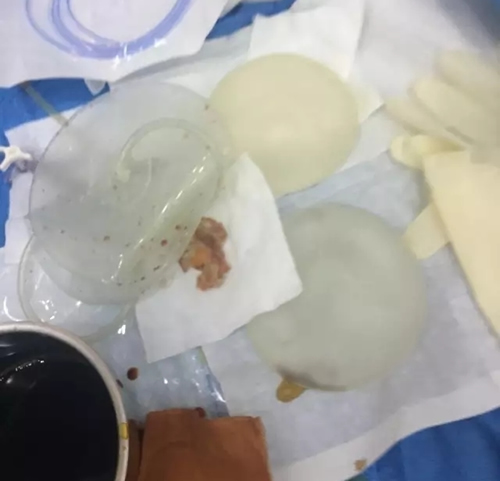 韩国麦恩医院隆胸假体取出实拍图