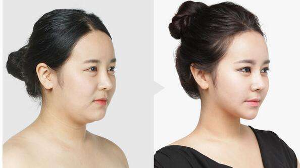 去颊脂垫手术瘦脸真的有效果吗？方法原理大揭秘！
