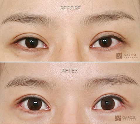 韩国整形医院双眼皮修复案例对比