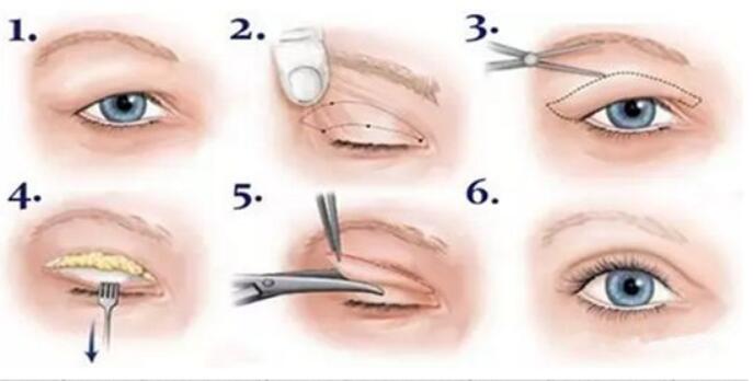 双眼皮修复手术方法