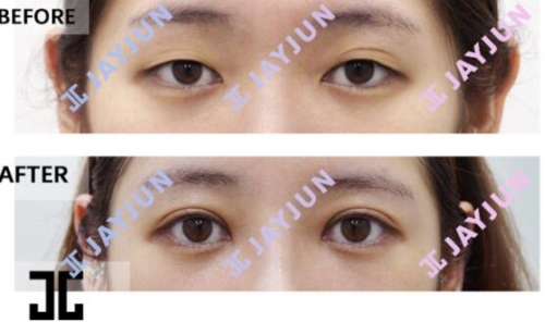 韩国JAYJUN双眼皮修复效果对比
