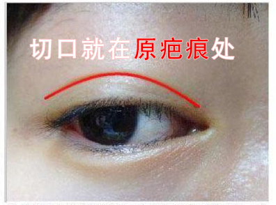 双眼皮怎么去疤方法示意图