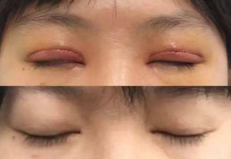 双眼皮祛疤修复前后对比照