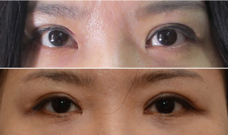 eve整形外科双眼皮修复案例对比