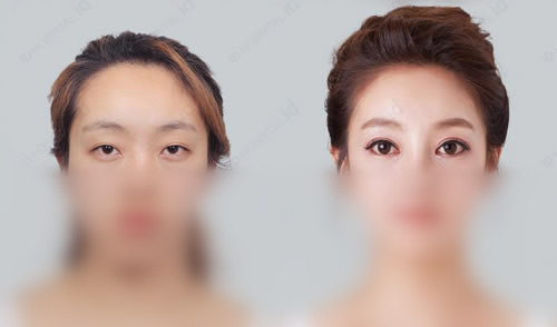 ID整形外科双眼皮整形案例