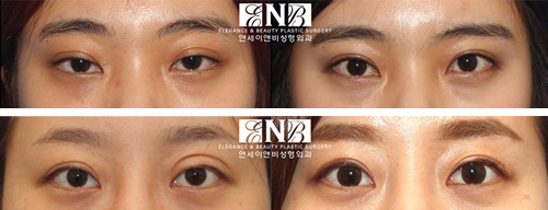 韩国延世enb医院双眼皮整形案例